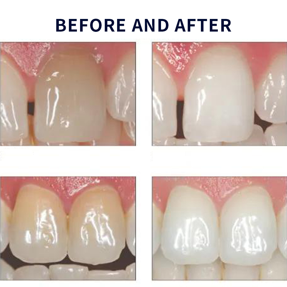 Opalescence Whitening 20% PF 2 - Teeth Whitening App ulasan dan harga