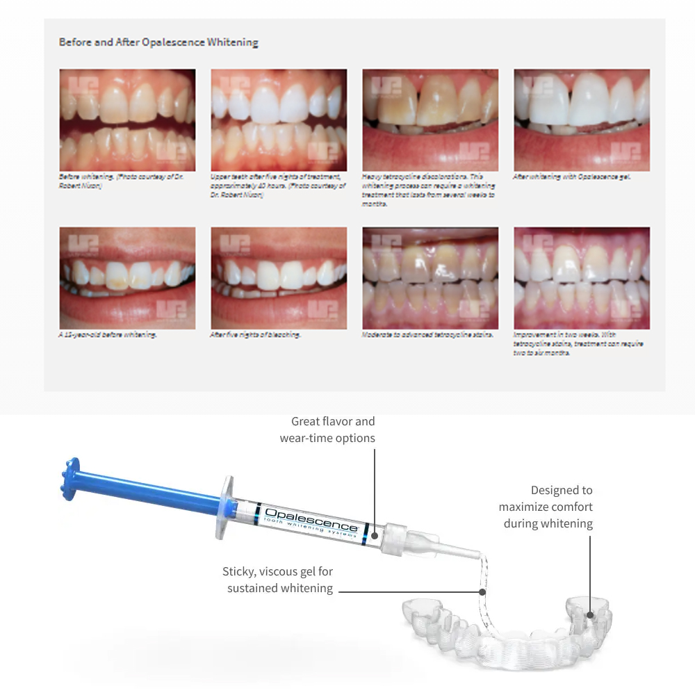 Opalescence Whitening 20% PF 2 - Teeth Whitening App ulasan dan harga