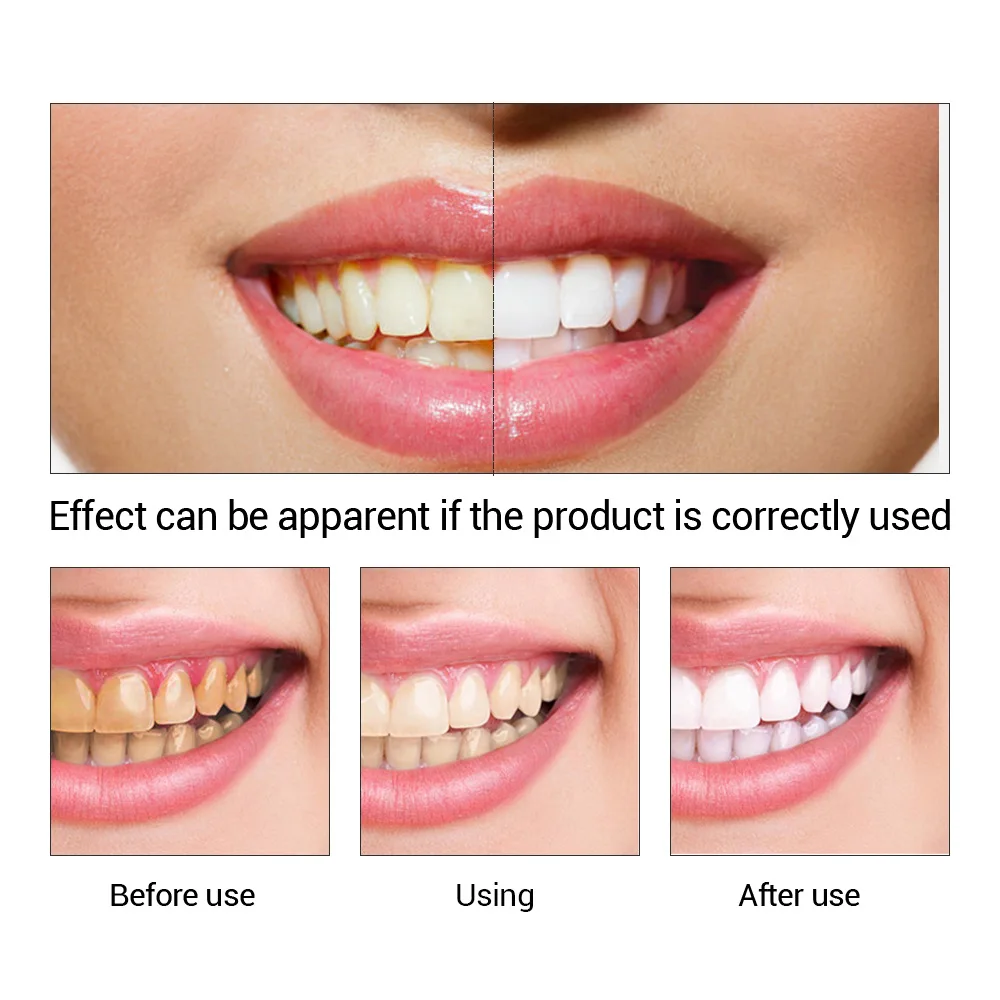 FTEENPLY Teeth Whitening Essen - Teeth Whitening App ulasan dan harga