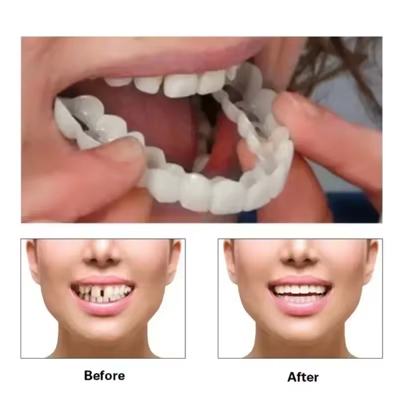 Teeth Veneers Whitening Dentur - Teeth Whitening Vape ulasan dan harga